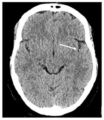 Multimodality Characterization of the Clot in Acute Stroke